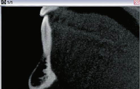 5). Na imagem transaxial obtida, com a representação do dente completo, inserido entre as corticais ósseas dentoalveolares e toda a anatomia mandibular da região, fez-se os procedimentos, com o