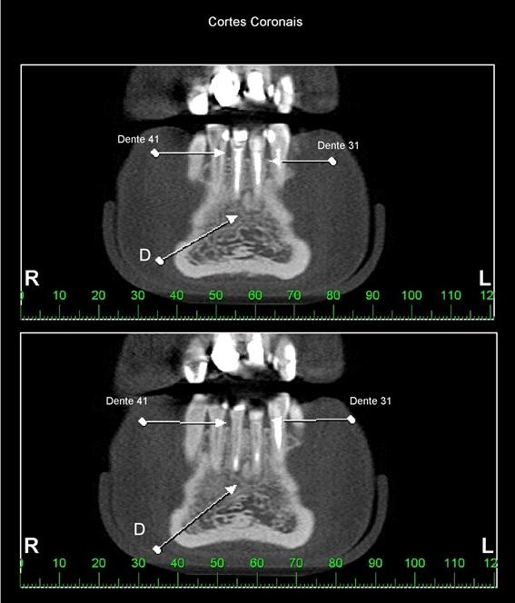 Boletim Informativo Setembro 2017 Cortes tomográficos coronais dos dentes incisivos centrais inferiores (Dentes 41 e 31),