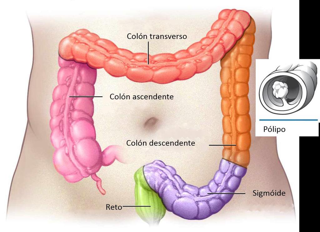 O cancro do colón e reto é um dos cancros mais comuns a nível mundial.