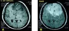 A espectroscopia por RM avalia no metabolismo cerebral a concentração de importantes marcadores neurológicos para o diagnóstico do tumor astrocitário.