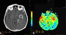 Figura 4: Imagem axial em difusão - Tumor astrocitário de IV grau (seta) Fonte: Aragão (2015).