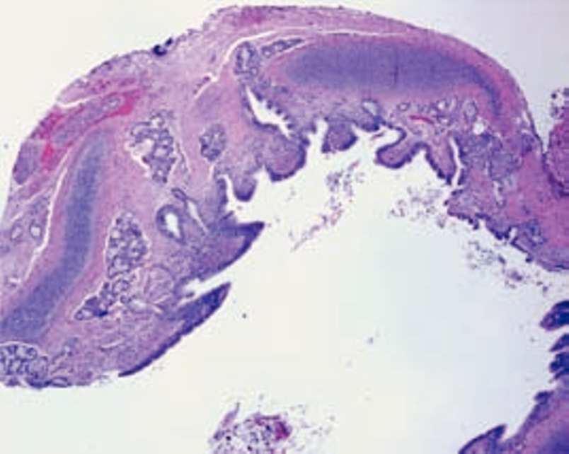 alveolares (caso clínico 3) Fig.