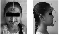 B) Máscara facial reversa Os indivíduos utilizaram a máscara facial modificada por Petit (Figura 2) Material E Método Amostra O presente estudo analisou amostra obtida de indivíduos tratados na