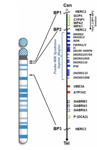 Discussão A síndrome de Prader-Willi (SPW) é uma doença genética com repercussão a nível de vários sistemas orgânicos, causada pela ausência de expressão de um conjunto de genes, localizados no