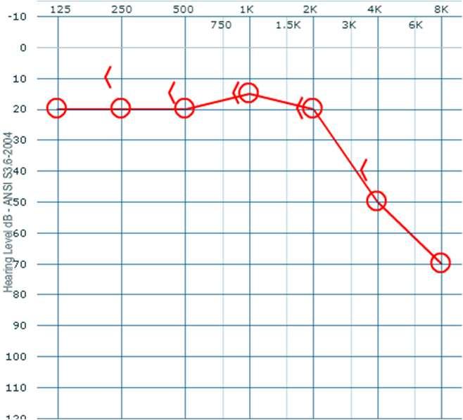 O.D. 25 db 100 O.E. 40 db 80 Figura 3: Audiograma tonal e vocal, 11 meses após estapedotomia esquerda de revisão e 3 meses após estapedotomia direita de revisão. Encerramento do GAO à direita.