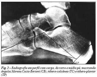 As radiografias permitiram a revisão biomecânica do pé, como também a avaliação dos pontos específicos.