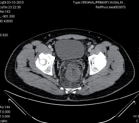 vada secundária a mutação genética, tendo iniciado anticoagulação com varfarina. Figura 1 Tomografia abdominopélvica: espessamento da parede do recto.