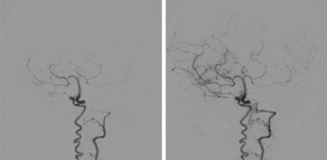 Fig. 6 Imagens de angiografia digital por subtração mostrando: A, B, D, E, estenose suboclusiva do segmento supraclinoide das artérias carótidas internas (setas brancas); C,