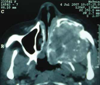 Corte axial de tomografia computadorizada mostrando tumor à esquerda, invadindo seio maxilar com extensão para órbita, seio frontal e etmoidal, fossa nasal e faringe