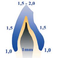 Em espessuras mais f nas, prense com 0,7mm e reduza com brocas diamantadas de corte f no até atingir a espessura de 0,5mm, utilizando um motor de baia rotação durante o desgaste.