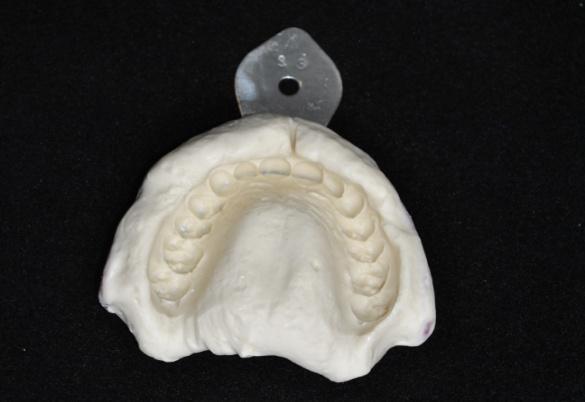 96 3. Confecção das placas resilientes Foram confeccionadas placas resilientes de silicone adaptadas à maxila dos pacientes e recomendado o seu uso noturno por 28 dias.