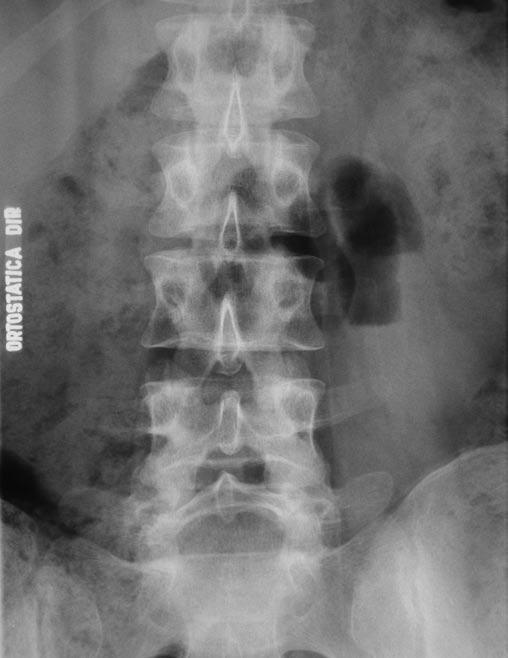 Vinheta Imagenológica Imagenologic Vignette Responsáveis: Artur da Rocha Corrêa Fernandes e Jamil Natour Contribuição dos Métodos de Diagnóstico por Imagem na Avaliação da Espondilólise Contribution