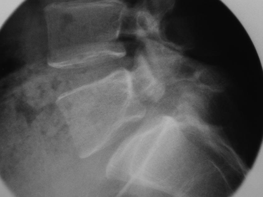 encurtamento ou sobreposição dos corpos vertebrais (7). A radiografia oblíqua mostra, em grande parte das vezes, o defeito radiotransparente no istmo.