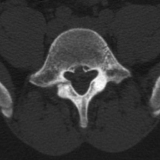 Imagem na Espondilólise Para avaliar a instabilidade, radiografias em perfil com flexão e extensão em posição ortostática podem ser realizadas.