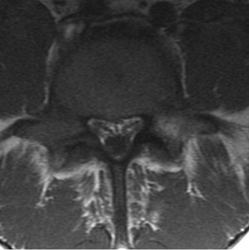 Foi proposto, também, o sinal da interposição da gordura epidural entre a dura-máter e o processo espinhoso (5) (Figura 8), que representa um sinal qualitativo do aumento do