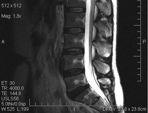 F G Figura 6 D, E, F e G - RM ponderada em T1 e T2 nos planos parassagital e axial evidenciam a linha de hipossinal na pars interarticularis com sinal com padrão de edema na