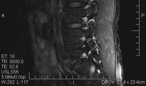O aumento do diâmetro ântero-posterior do canal no nível do defeito pode ser visto tanto pelo deslocamento anterior do corpo vertebral em relação aos elementos posteriores