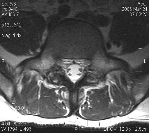 O tipo mais freqüentemente encontrado é a conversão gordurosa, caracterizada por hipersinal em T1 e T2 (2) (Figura 8).