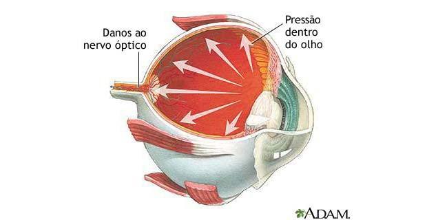 Sintomas: Como indentificar: Um exame ocular pode ser usado para identificar o glaucoma. O médico precisará examinar o interior do olho, observando através da pupila, que geralmente é dilatada.