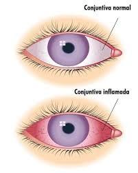 combinação de vários sintomas pode estar presente na conjuntivite como: coceira, olhos avermelhados e lacrimejando em excesso, visão embaçada e sensível à claridade, inchaço das pálpebras, e ainda