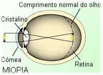 Fadiga ocular Dores de cabeça (incomum) Astigmatismo é uma imperfeição comum, leve e facilmente tratável na curvatura do olho.