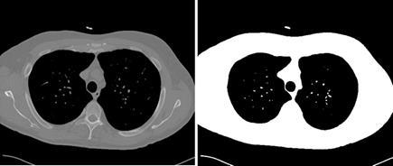 Figura 14 - Exemplo de segmentação do tórax. É aplicada uma limiarização, cujo limiar é -500 HU. Tudo abaixo desse limiar é considerado fundo e pintado de preto.