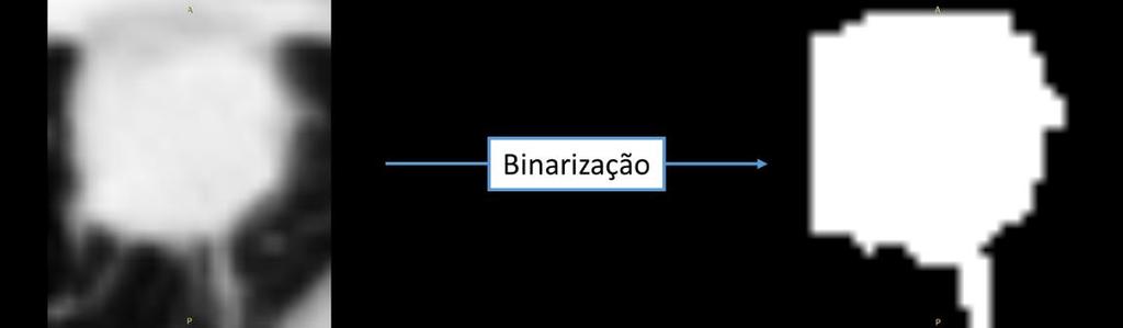 Figura 33 Binarização da massa. Após a binarização será aplicada uma operação para extração das bordas do volume.