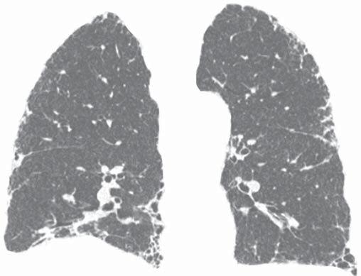 s pneumonias intersticiais de evolução crônica nas doenças do colágeno possuem, em geral, melhor prognóstico do que as de natureza idiopática, com melhor tempo de sobrevida em cinco anos (Figura 4)