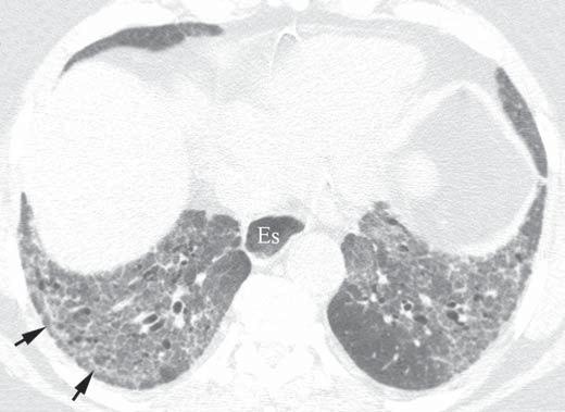 Silva CIS, Müller NL Figura 4. Evolução tomográfica de pneumonia intersticial não-específica em paciente com esclerose sistêmica progressiva recebendo tratamento com corticosteróide.