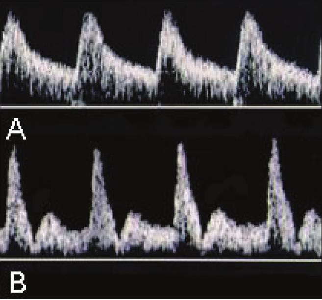 Villas-Bôas JMS, Maestá I, Consonni M Figura 1 Onda de velocidade de fluxo na artéria uterina. (A) normal (após segunda onda de invasão trofoblástica).