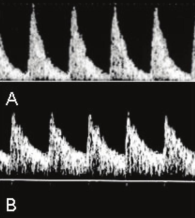 Villas-Bôas JMS, Maestá I, Consonni M Figura 4 Onda de velocidade de fluxo na artéria cerebral média.
