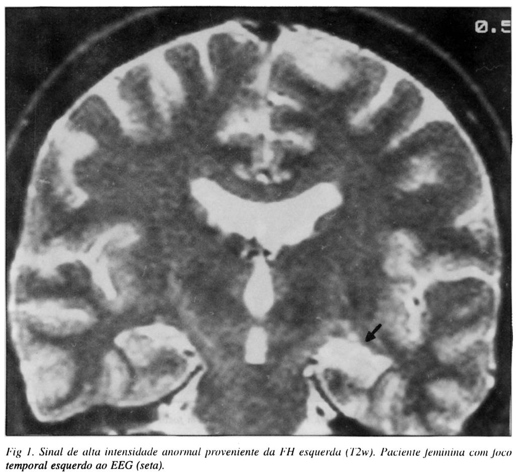 anormais de alta intensidade. RESULTADOS Em 3 pacientes a MRI foi conclusiva na lateralização do foco epileptogênico.