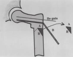 Fig. 6 A) Corte paralelo ao prego da placa; B) corte paralelo à haste da placa. Fig. 8 Placa angulada fixada à cortical e cunha óssea inserida no lado medial Fig.