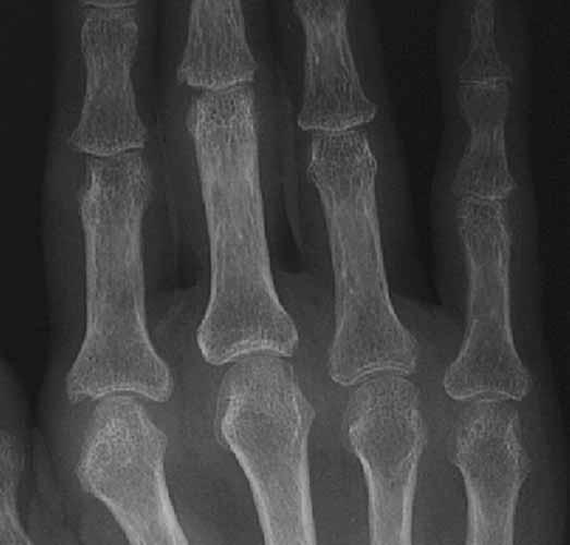 dactilar do pé Fase de latência (anos) Fase tardia erosões ósseas para-articulares