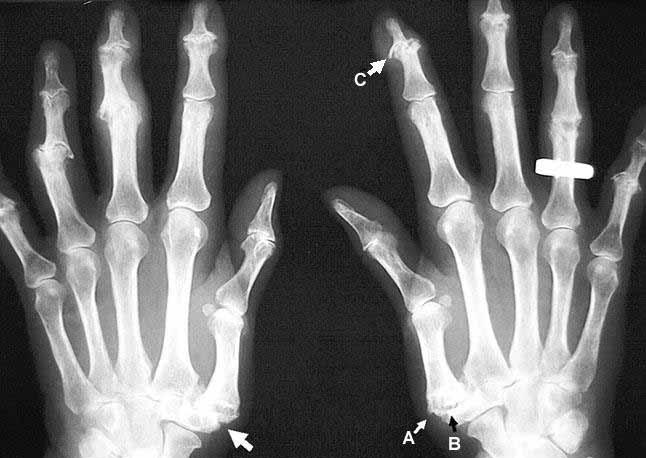 6. Osteopatias metabólicas Osteoporose redução da massa óssea pós-menopausa corticoterapia hiperparatiroidismo Radiologia redução da