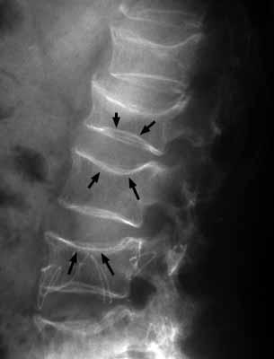 6. Osteopatias metabólicas Osteoesclerose aumento