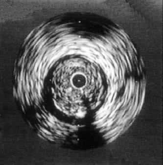 Figura 3: Imagem ultra-sonográfica, demonstrando a presença de placa fibrótica.