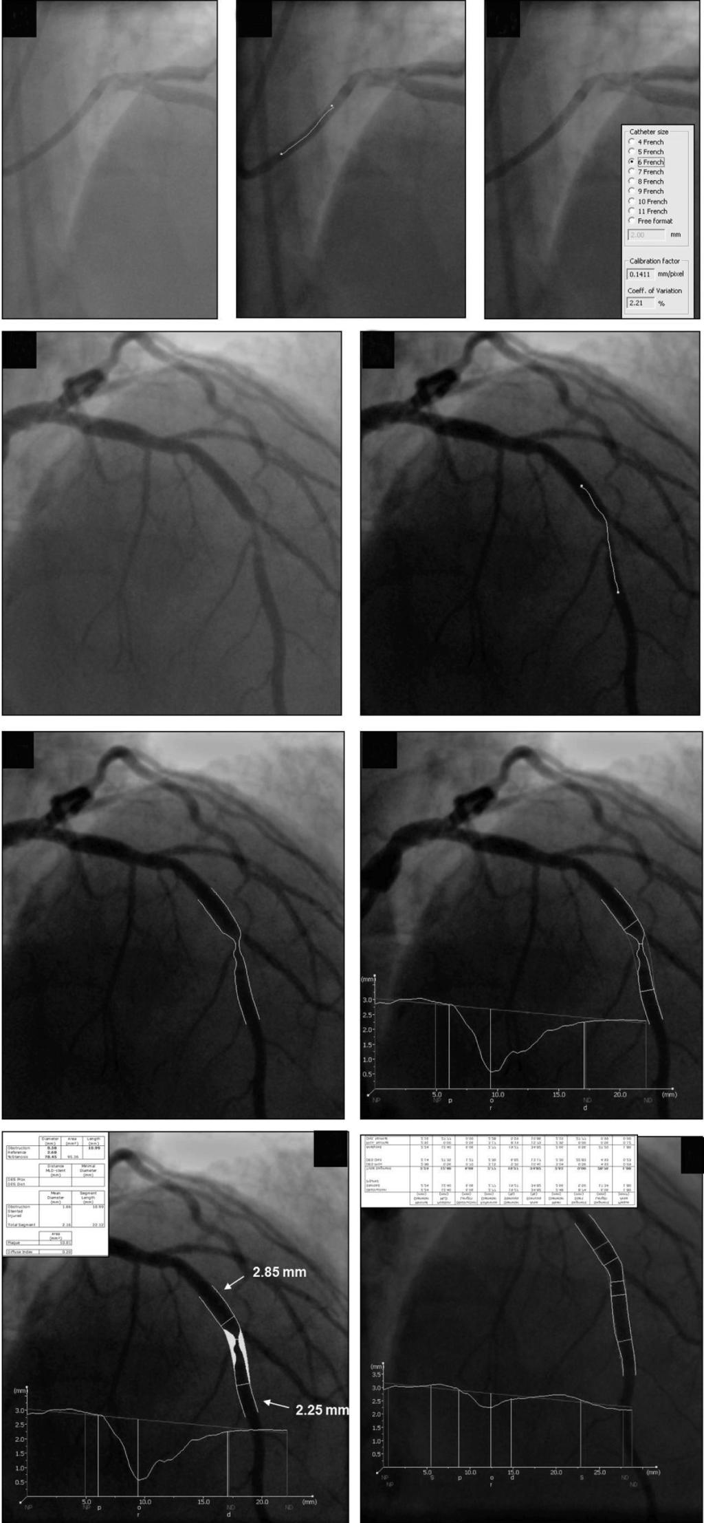 Capítulo 19 Angiografia coronária quantitativa: métodos e aplicações (MCA), que procura uma trajetória de contorno ótima ao longo de todo o segmento.