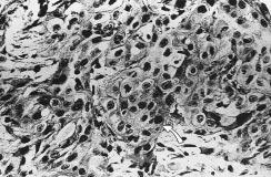 FIGURA 5 - Carcinoma invasivo. Detalhe evidenciando células neoplásicas arranjadas em ninhos sólidos que invadem o tecido conjuntivo subjacente (H. E., 400 X).