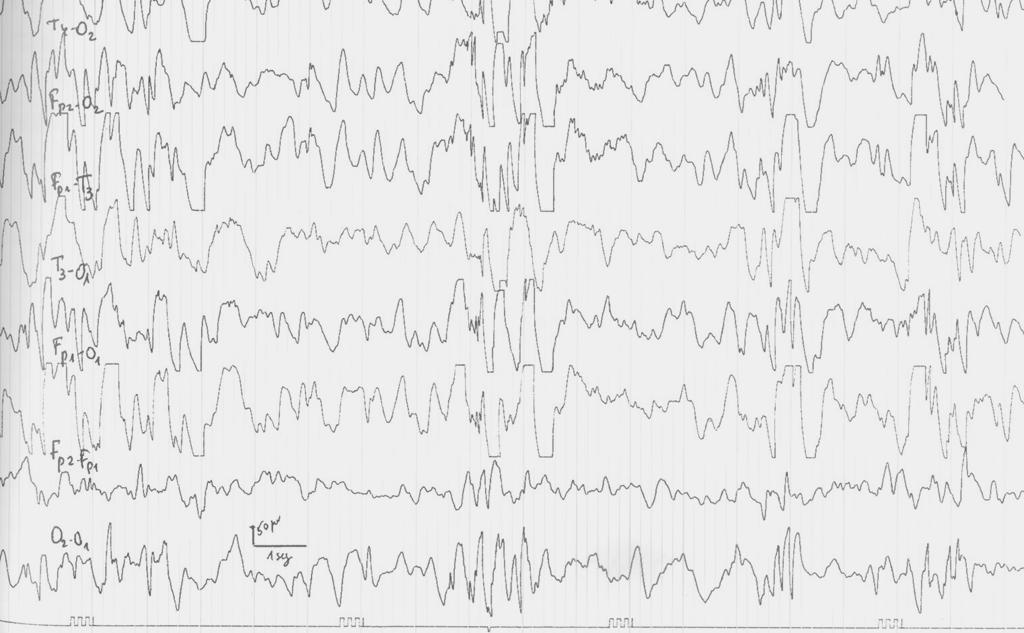 epiléptica EEG normal http://www.