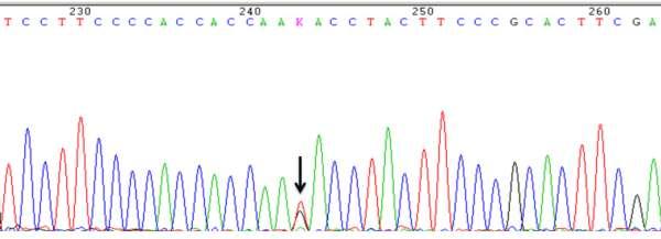 Resultados 2.1.3. ESTUDOS MOLECULARES A sequenciação de ADN mostrou a presença da alteração AAG AAT no codão 40 do gene 1 (Figura 29).