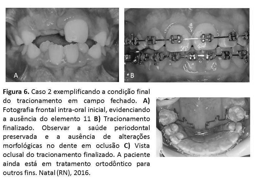 19 O reposicionamento apical do retalho expõe a coroa dentária, possibilitando um tracionamento em campo aberto.