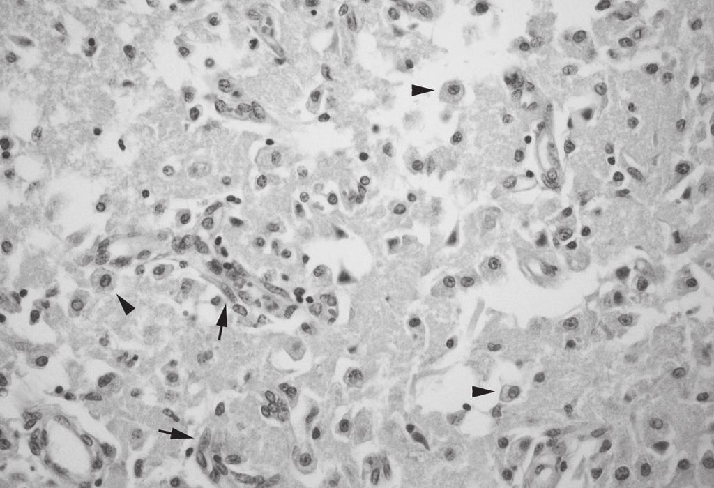 Há necrose de neurônios que têm o citoplasma acidofílico e núcleo picnótico (neurônios
