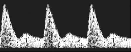 imagem da tela para análise; e) no sonograma obtido, o contorno da onda correspondente a um ciclo cardíaco completo foi delineado manualmente pela técnica ponto a ponto, e os índices