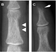 Alterações Radiológicas: Reabsorção subperiosteal em falange média(b) + Reabsorção e Acro-osteólise com