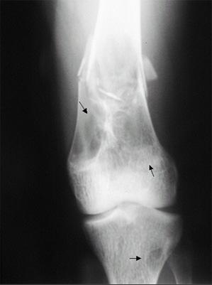 Osteoclastomas Tumor Marrom lesão císticas radiotransparente com contornos bem definidos(halo