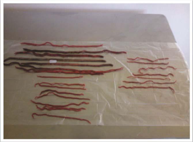 Perera et al. Figura 1. Exemplares de Dioctophyme renale removidos cirurgicamente da cavidade abdominal do paciente canino. Fonte: Arquivo fotográfico do PRODiC.