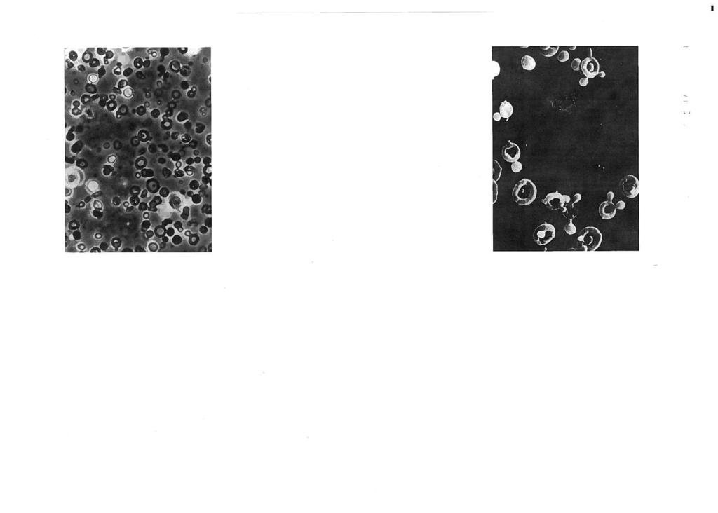 vi ISABEL 1) ~N1[ L ei ai Figura 2 - Acantocitos observados por microscopia electrónica (x 1000) baixas contagens de eritrocitos 19 Foi demonstrado que a especificidade do acantocito é mais elevada