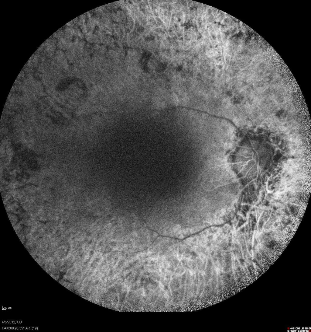 55 Unilateral Retinitis INTRODUCTION Retinitis Pigmentosa (RP) is a group of inherited disorders of the retina which are characterized by progressive damage involving photoreceptors and often,