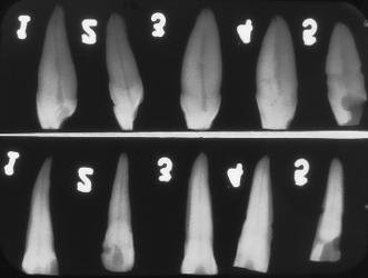Os grupos foram obturados endodonticamente pela técnica preconizada na disciplina de Odontopediatria da UFSC para dentes decíduos.